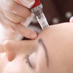 Micro-needling Procedure