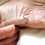 Types of Skin Disorders