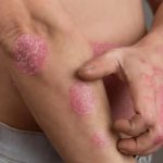 Alternative Treatment for Psoriasis