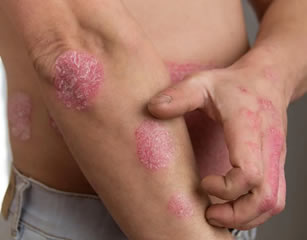 Alternative Treatment for Psoriasis