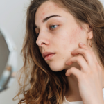 How to Prevent Acne Breakouts for Clear, Healthy Skin